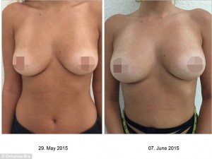 breast