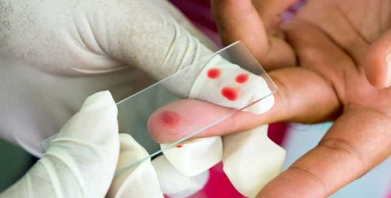 malaria OrijoReporter.com, using urine for malaria test