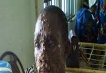 OrijoReporter.com, monkeypox virus