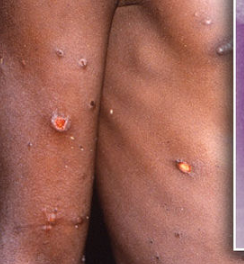 MONKEYPOX